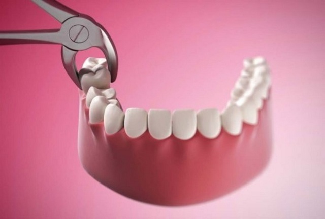 Nhổ răng có đau không? – Trong quá trình nhổ răng bạn sẽ không cảm thấy đau đớn