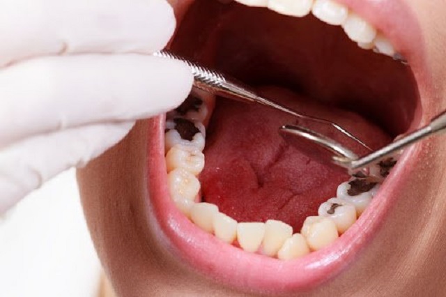 Nhổ răng sâu giúp hạn chế tình trạng sâu lan ra răng xung quanh
