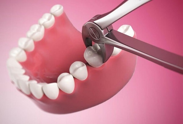 Nhổ răng sẽ được chỉ định trong những trường hợp nào?