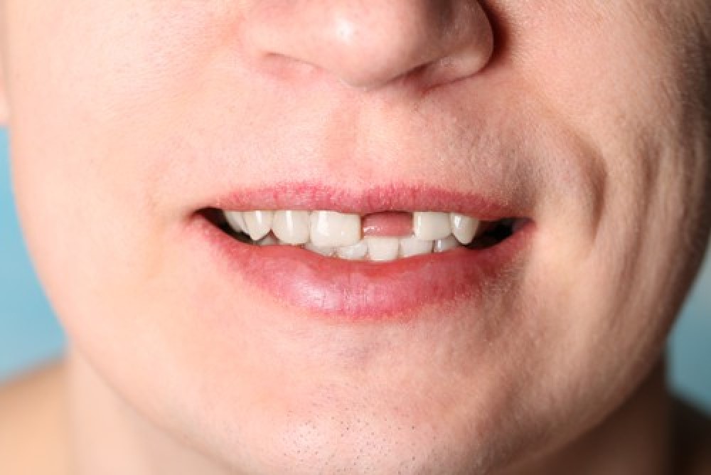 Những người bị mất răng nên đi cấy ghép răng implant.
