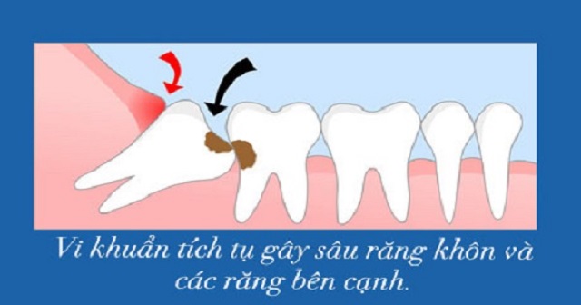 Phá hủy cấu trúc bộ răng