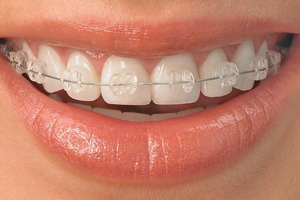Phương pháp niềng răng mắc cài sứ mang lại tính thẩm mỹ cao.