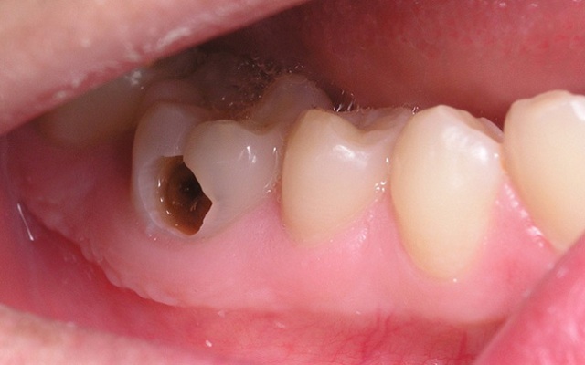 Phương pháp trám răng là giải pháp khắc phục lỗ sâu hiệu quả