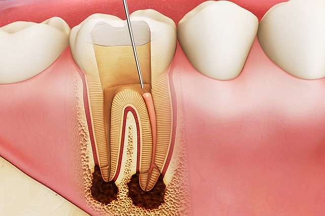 Quy trình chữa tủy răng mất bao lâu?