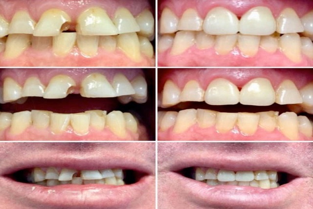 Quy trình trám răng chuyên nghiệp tại phòng khám đa khoa