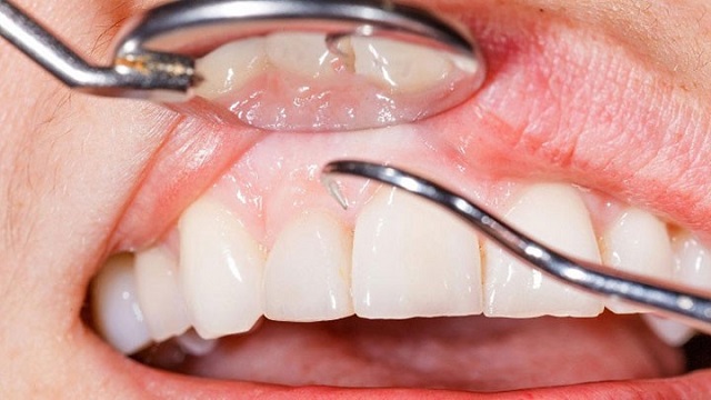 Quy trình lấy cao răng bằng công nghệ hiện đại