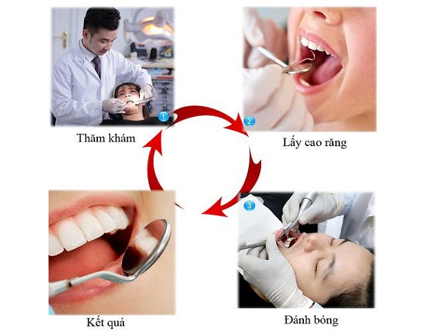 Quy trình lấy cao răng gồm 4 bước