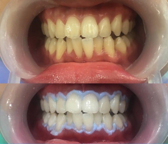 Quy trình tẩy trắng răng