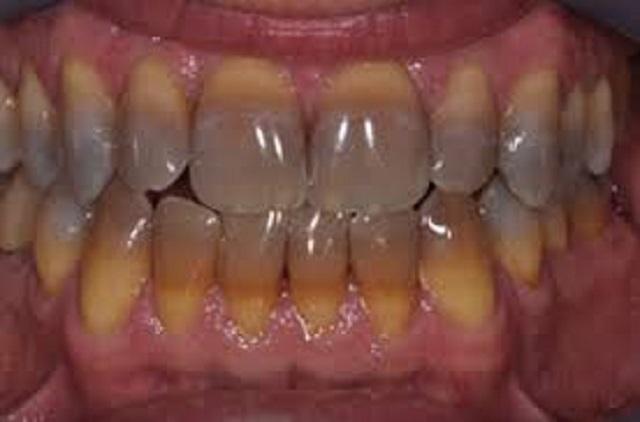 Răng bị nhiễm màu ở từ bên trong