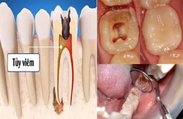 Răng bị sâu ăn vào tủy cần phải lấy bỏ tủy