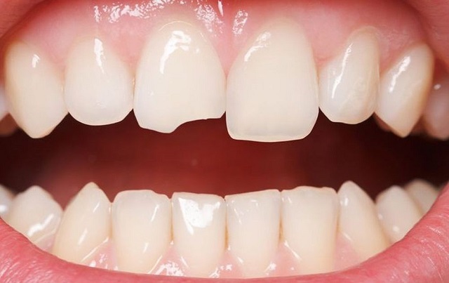 Răng bị vỡ do tác động của ngoại lực