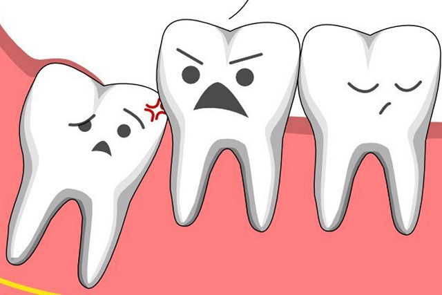 Răng khôn gây ảnh hưởng đến răng liền kề và chức năng ăn nhai của cả hàm