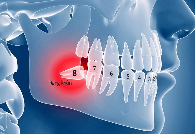 Răng khôn sẽ mọc ở vị trí trong cùng của hàm răng