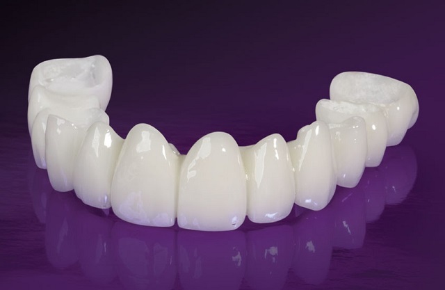 Răng sứ toàn sứ là loại được chế tạo từ sứ nguyên khối