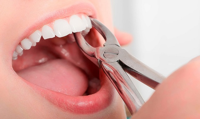 Sau khi nhổ răng bạn hãy theo dõi vết nhổ để kịp thời xử lý giảm đau