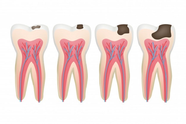 Sâu răng không được chữa trị kịp thời sẽ gây ảnh hưởng nghiêm trọng đến sức khỏe răng miệng