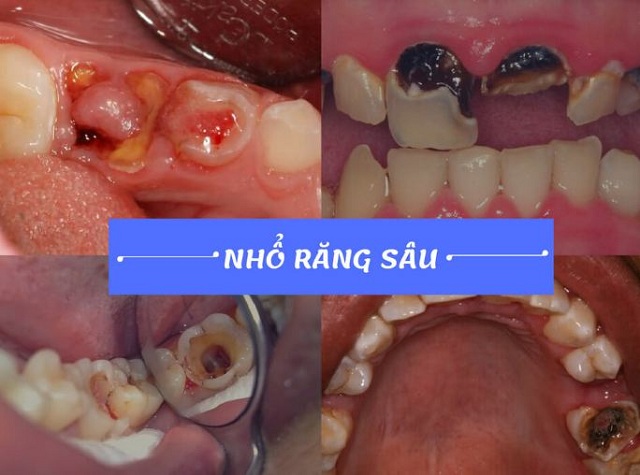 Sâu răng nghiêm trọng cần phải nhổ bỏ để tránh ảnh hưởng đến những chiếc răng bên cạnh