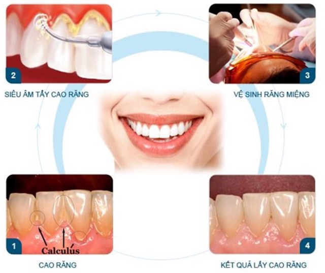 Sơ lược về quy trình cạo vôi răng