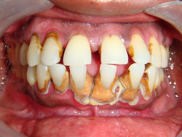 Tác hại của cao răng