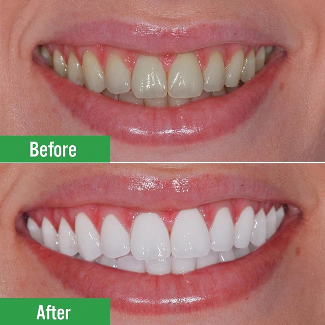 Tẩy răng trắng đem lại khá nhiều ưu điểm nhưng không phải ai cũng có thể thực hiện được.