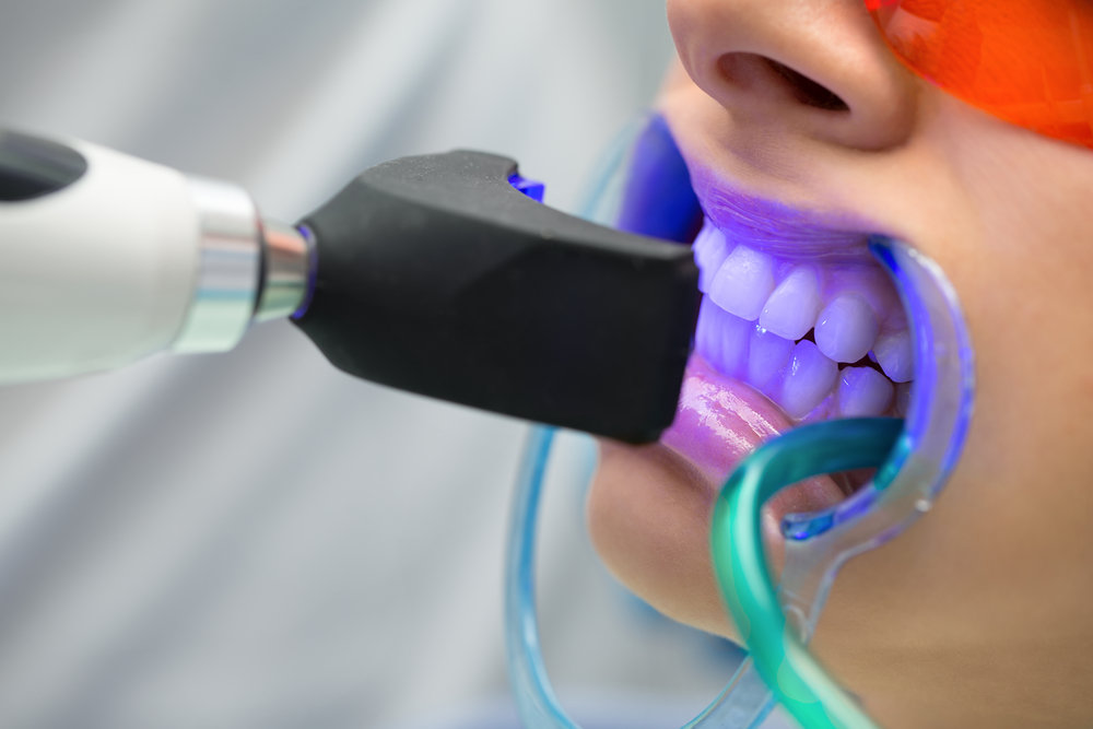 Tẩy trắng răng bằng phương pháp hiện đại có thể giữ màu từ 3 - 5 năm.