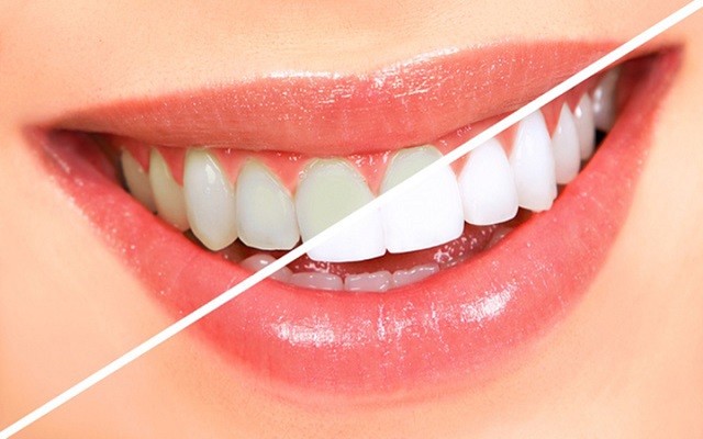 Tẩy trắng răng giá bao nhiêu được rất nhiều người quan tâm.