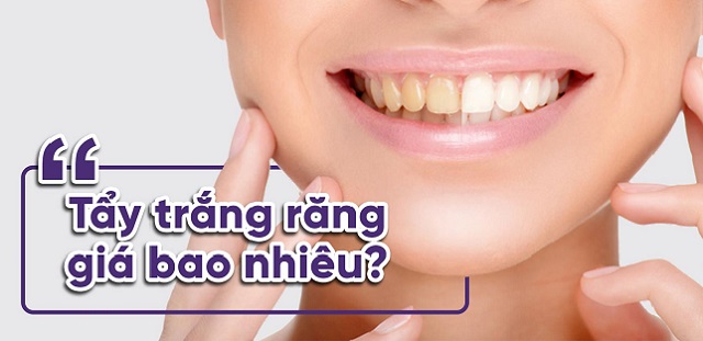 Tẩy trắng răng giá cụ thể là bao nhiêu ?