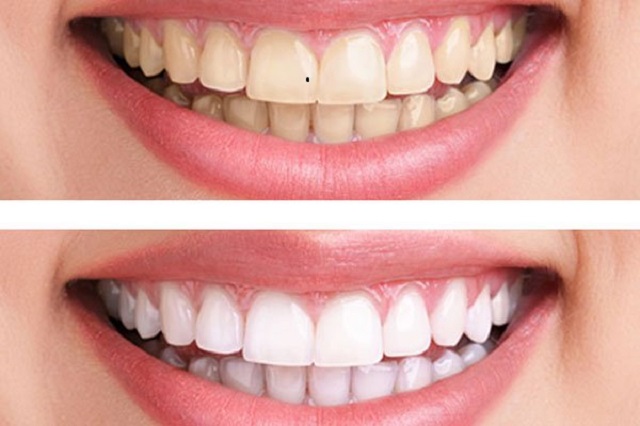 Tẩy trắng răng là gì?