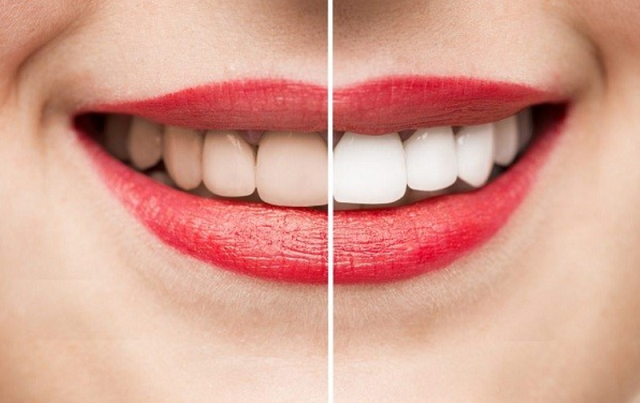 Tẩy trắng răng là gì