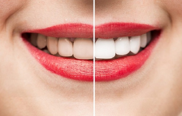 Tẩy trắng răng Laser Whitening mang đến hiệu quả trắng sáng bất ngờ