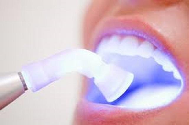 Tẩy trắng răng tại nha khoa nhờ công nghệ Laser Whitening