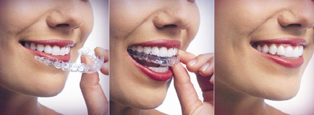 Thời gian niềng răng tùy thuộc vào tình trạng răng hàm của mỗi người