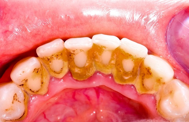Tìm hiểu cạo vôi răng là gì?
