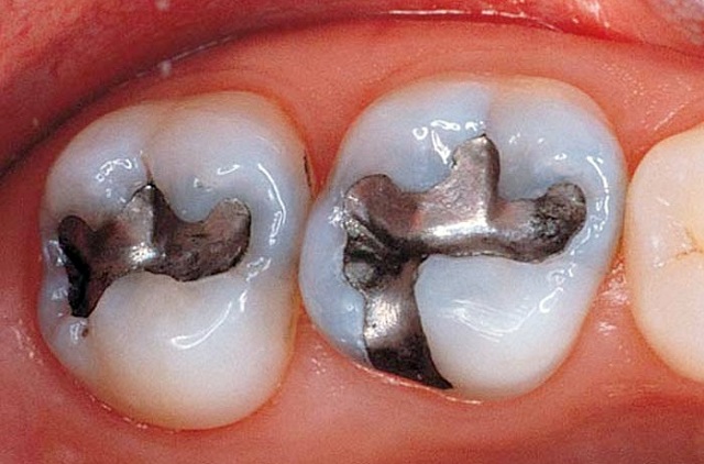 Tìm hiểu trám răng là gì và có tác dụng như thế nào?