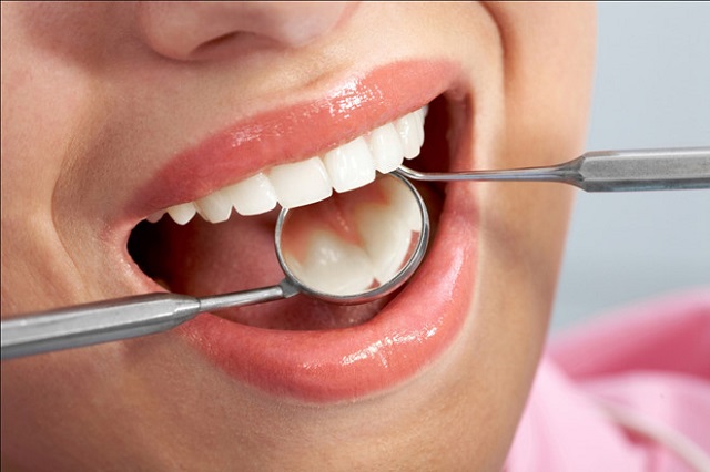 Trám răng bao nhiêu tiền phù thuộc vào tùy tình trạng của răng