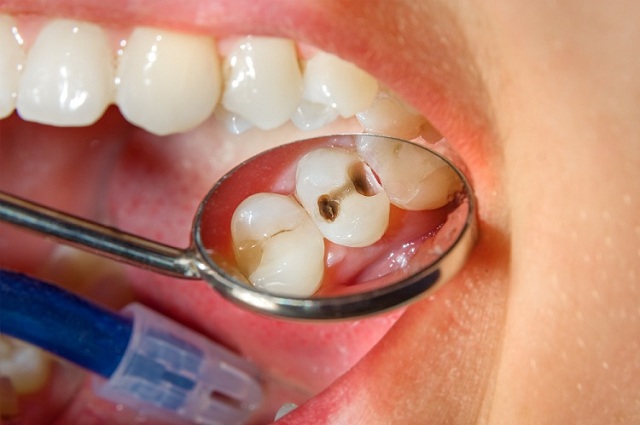 Trám răng gồm 5 bước