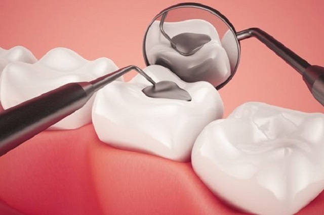 Trám răng là hình thức điều trị sâu răng được áp dụng phổ biến nhất