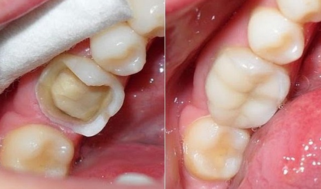 Trám răng là một phương pháp giúp phục hồi lại chức năng của những chiếc răng đã bị hỏng