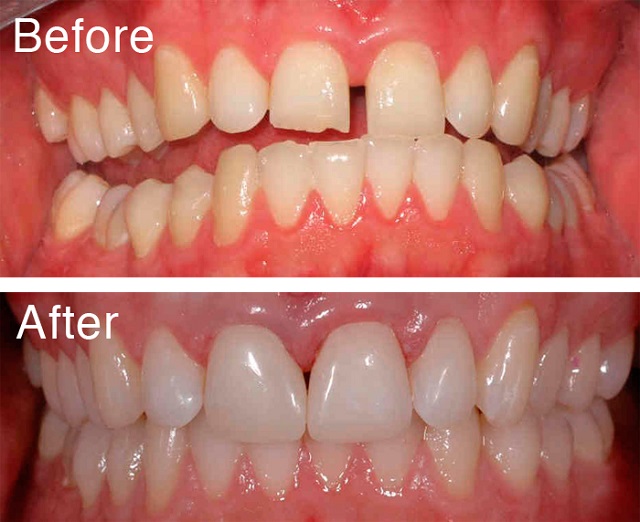 Trám răng là phương pháp thẩm mỹ để làm đẹp cho hàm răng