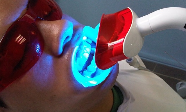Tẩy trắng răng bằng laser
