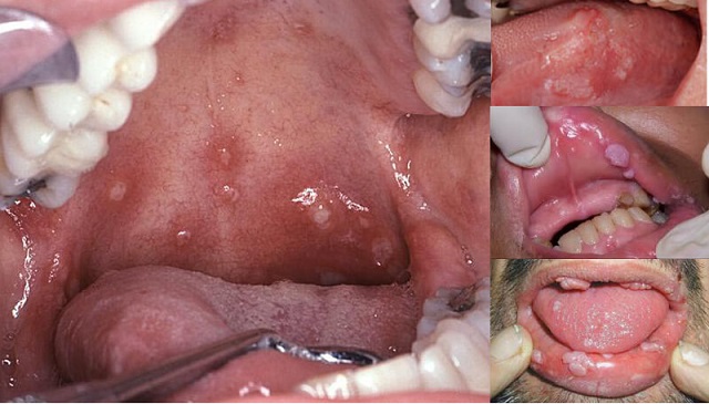 Triệu chứng của bệnh sùi mào gà xuất hiện ở lưỡi