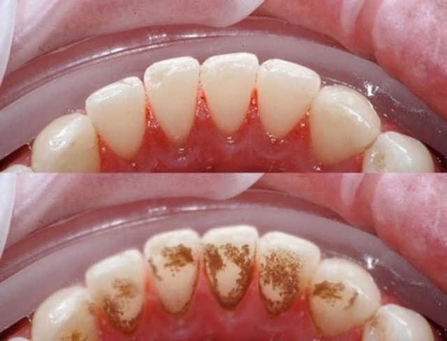 Trước và sau khi cạo vôi răng.