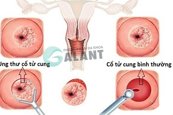 ung thu co tu cung giai doan 2b 2