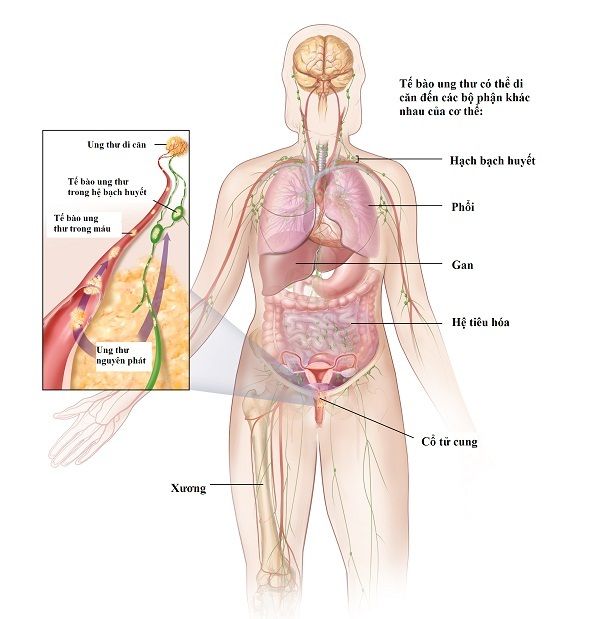 ung thu co tu cung giai doan cuoi