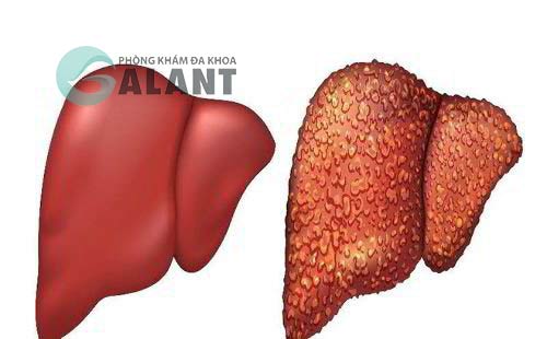 Bệnh viêm gan B có lây qua đường ăn uống không?