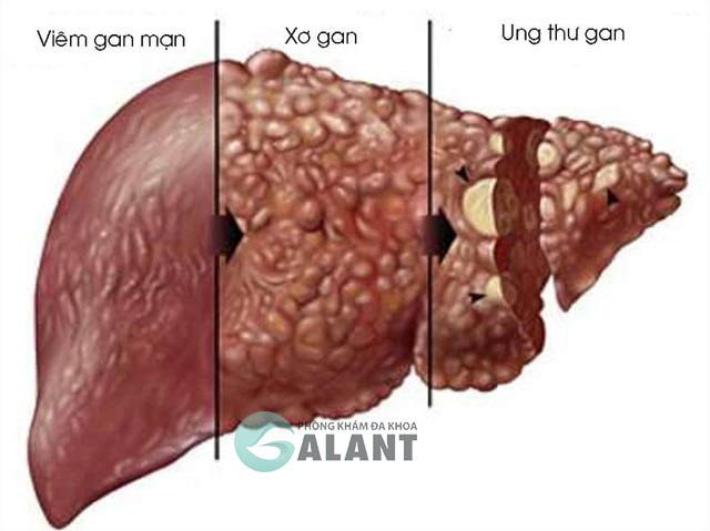 Viêm gan B mạn tính tiến triển nguy hiểm thể nào?