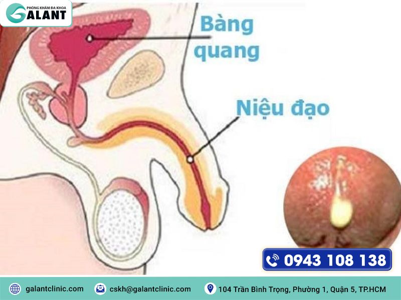 Dịch niệu đạo là gì