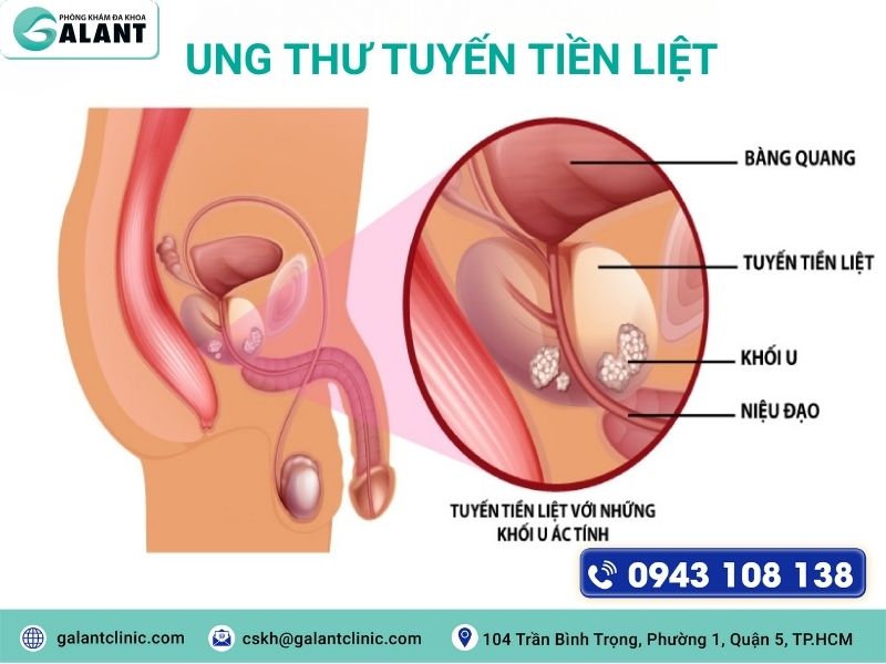 xet nghiem psa tam soat ung thu tuyen tien liet 2