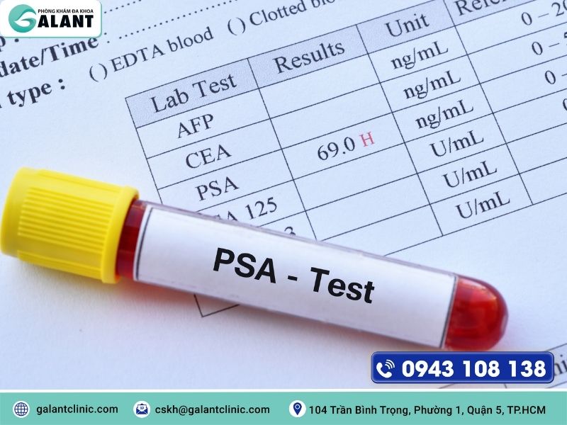 xet nghiem psa tam soat ung thu tuyen tien liet