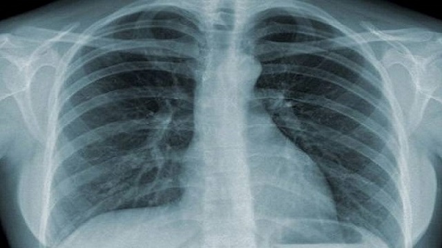 viêm phổi do pneumocystis